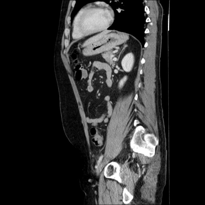 Acute cholecystitis and incidental left sided IVC (Radiopaedia 49352-54459 Sagittal C+ portal venous phase 35).jpg