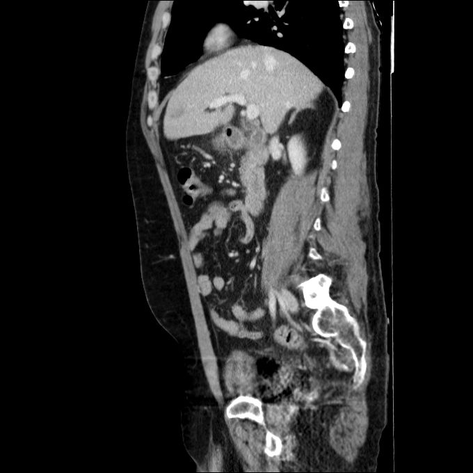Acute cholecystitis and incidental left sided IVC (Radiopaedia 49352-54459 Sagittal C+ portal venous phase 56).jpg