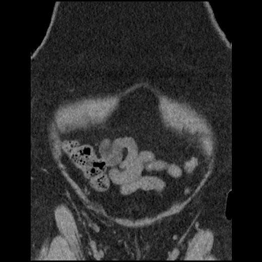 File:Acute cholecystitis and ureteric colic (Radiopaedia 42330-45444 Coronal prone 22).jpg