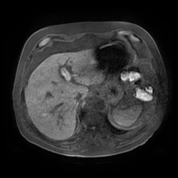 Acute cholecystitis complicated by pylephlebitis (Radiopaedia 65782-74915 Axial T1 fat sat 24).jpg