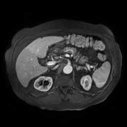 Acute cholecystitis complicated by pylephlebitis (Radiopaedia 65782-74915 Axial arterioportal phase T1 C+ fat sat 58).jpg