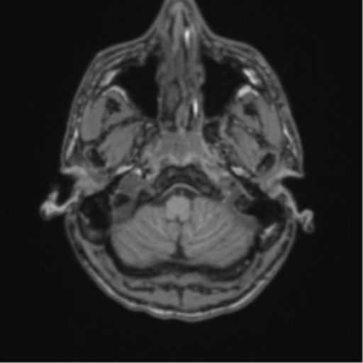 Acute disseminated encephalomyelitis (ADEM) (Radiopaedia 65319-74349 Axial T1 4).png