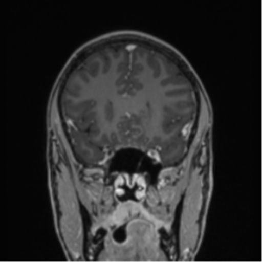 Acute disseminated encephalomyelitis (ADEM) (Radiopaedia 65319-74349 Coronal T1 C+ 40).png