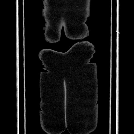 File:Acute diverticulitis - transverse colon (Radiopaedia 87063-103327 Coronal C+ portal venous phase 164).jpg