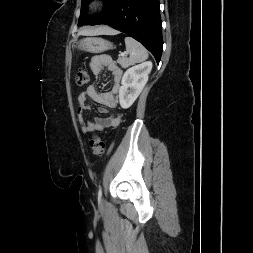 Acute diverticulitis - transverse colon (Radiopaedia 87063-103327 Sagittal C+ portal venous phase 161).jpg