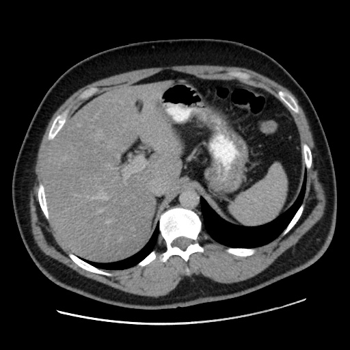 Acute diverticulitis with localized perforation (Radiopaedia 41296-44113 Axial C+ portal venous phase 22).jpg
