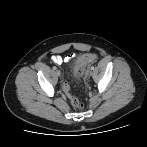 File:Acute diverticulitis with localized perforation (Radiopaedia 41296-44113 Axial C+ portal venous phase 77).jpg