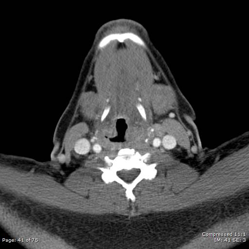 Acute epiglottitis (Radiopaedia 54375-60590 Axial C+ arterial phase 41).jpg