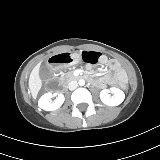 Acute gangrenous appendicitis with perforation (Radiopaedia 40152-42662 Axial C+ portal venous phase 29).png