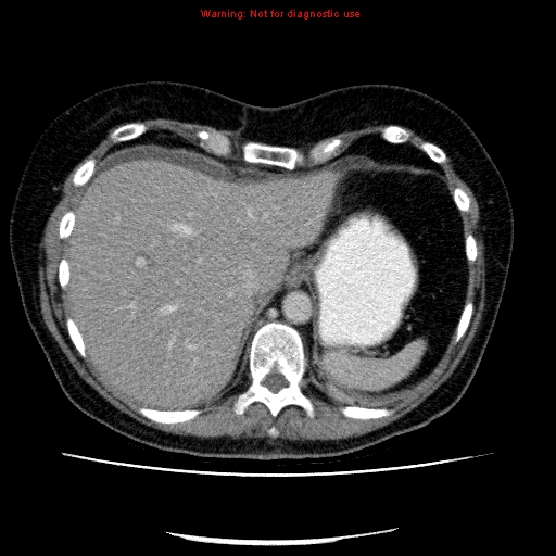 File:Acute gangrenous cholecystitis (Radiopaedia 10123-10661 Axial C+ portal venous phase 17).jpg