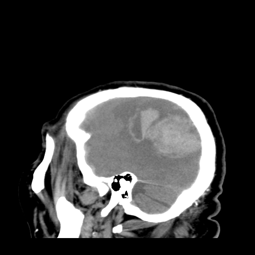 File:Acute hemorrhagic stroke (Radiopaedia 17507-17223 Sagittal non-contrast 8).jpg