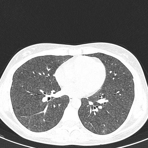 File:Acute hypersensitivity pneumonitis (Radiopaedia 85293-100870 Axial lung window 71).jpg