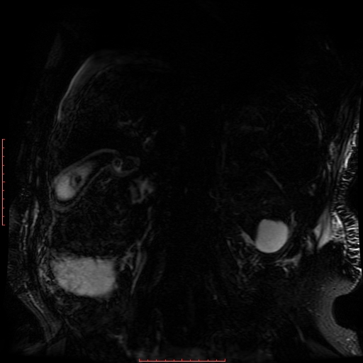 Acute necrotizing pancreatitis (Radiopaedia 28194-28448 Coronal MRCP 15).jpg
