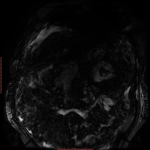 Acute necrotizing pancreatitis (Radiopaedia 28194-28448 Coronal MRCP 83).jpg