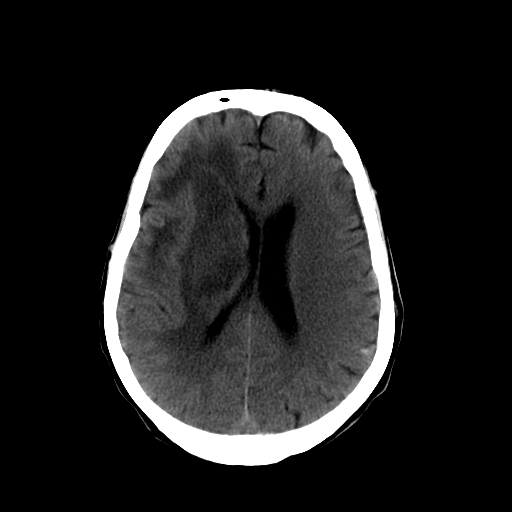 File:Acute necrotizing toxoplasma encephalitis (Radiopaedia 10683-11150 B 13).jpg