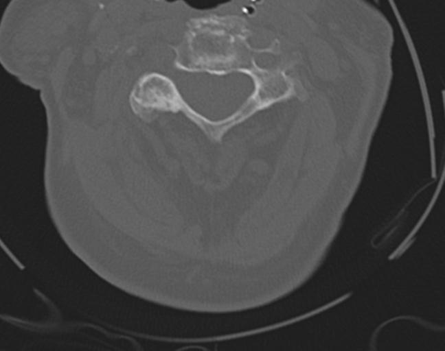 Acute on chronic subdural hematoma and thoracic vertebral injury in a multitrauma patient (Radiopaedia 31698-32619 Axial bone window 23).jpg