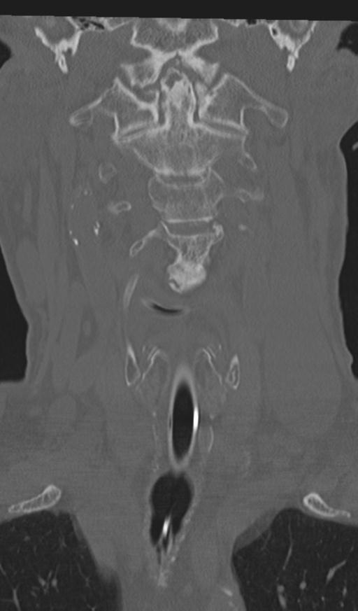Acute on chronic subdural hematoma and thoracic vertebral injury in a multitrauma patient (Radiopaedia 31698-32619 Coronal bone window 14).jpg