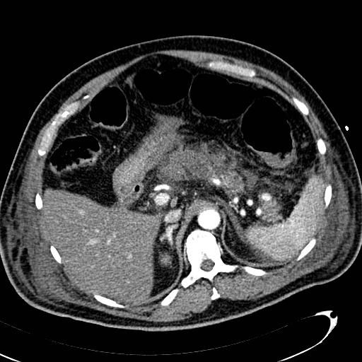 File:Acute pancreatic necrosis (Radiopaedia 13560-13486 Axial C+ portal venous phase 47).jpg