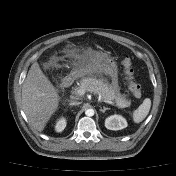 Acute pancreatitis (Radiopaedia 26663-26813 Axial C+ arterial phase 33).jpg