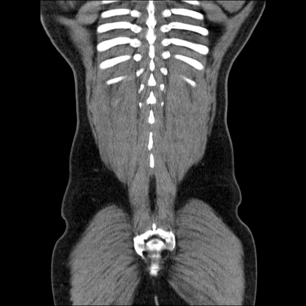 Acute pancreatitis (Radiopaedia 26663-26813 Coronal C+ portal venous phase 57).jpg