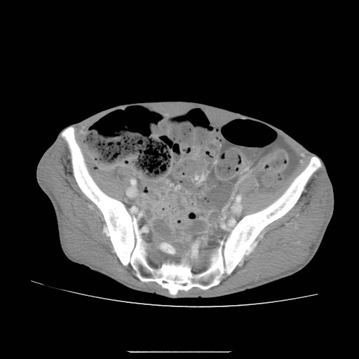 File:Acute pancreatitis (Radiopaedia 50213-55558 Axial C+ portal venous phase 47).jpg