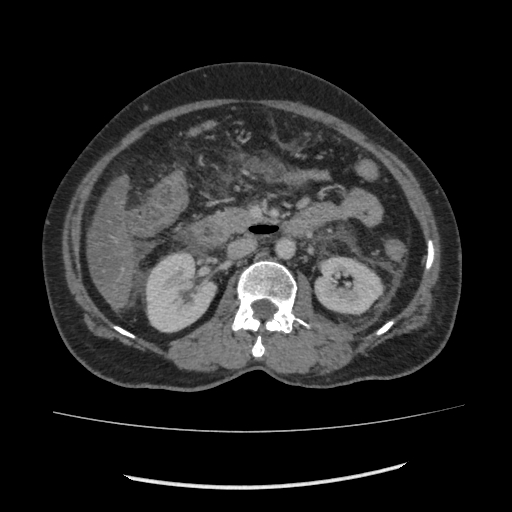 Acute pancreatitis (Radiopaedia 80007-93285 Axial C+ portal venous phase 83).jpg