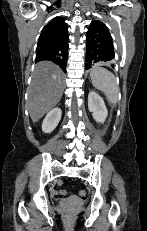Acute pancreatitis (Radiopaedia 80007-93285 Coronal C+ portal venous phase 123).jpg