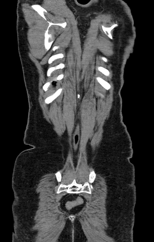 Acute pancreatitis (Radiopaedia 80007-93285 Coronal C+ portal venous phase 144).jpg