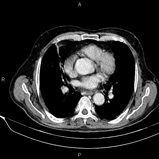 Acute pancreatitis (Radiopaedia 85146-100701 Axial C+ portal venous phase 6).jpg