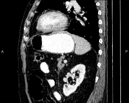 Acute pancreatitis (Radiopaedia 85146-100701 Sagittal C+ portal venous phase 66).jpg