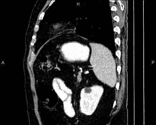 Acute pancreatitis (Radiopaedia 85146-100701 Sagittal C+ portal venous phase 76).jpg