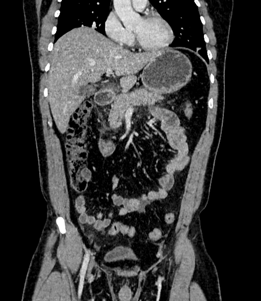 Acute pancreatitis (Radiopaedia 87428-103757 Coronal C+ portal venous phase 36).jpg