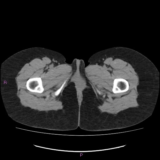 Acute pancreatitis secondary to stone at minor papilla and pancreatic divisum (Radiopaedia 76570-88333 Axial non-contrast 88).jpg