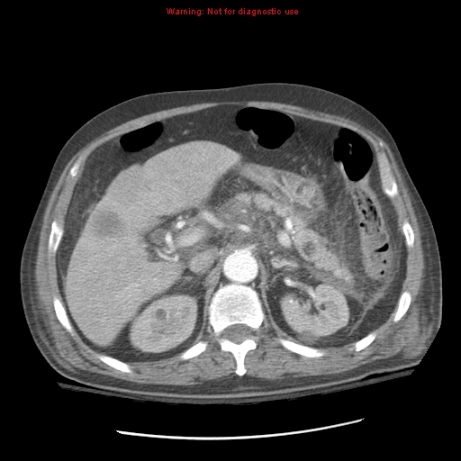 File:Acute pancreatitis with incidental pancreatic lipoma (Radiopaedia 10190-10730 Axial C+ arterial phase 33).jpg