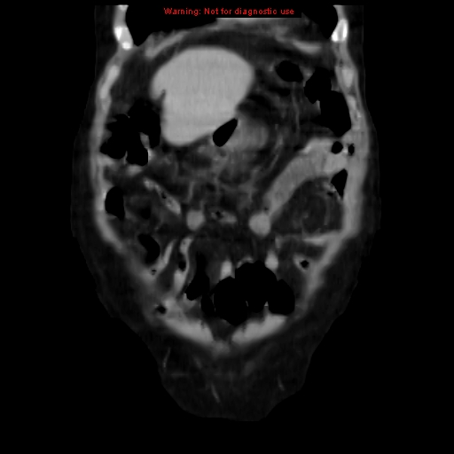 Acute pancreatitis with incidental pancreatic lipoma (Radiopaedia 10190-10730 Coronal C+ portal venous phase 12).jpg