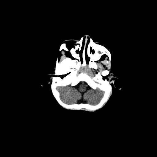 Acute phase of hemiconvulsion-hemiplegia epilepsy syndrome (Radiopaedia 29309-29744 Axial non-contrast 46).jpg