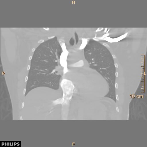 File:Acute reversible pulmonary hypertension and right heart failure from cocaine toxicity (Radiopaedia 49394-54517 Coronal C+ CTPA 20).jpg