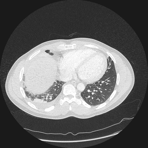 Acute segmental pulmonary emboli and pulmonary infarction (Radiopaedia 62264-70444 Axial lung window 138).jpg