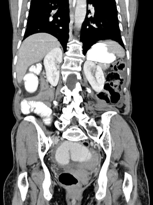 Acute small bowel (ileal) volvulus (Radiopaedia 71740-82139 Coronal C+ portal venous phase 78).jpg