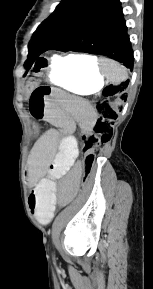 Acute small bowel (ileal) volvulus (Radiopaedia 71740-82139 Sagittal C+ portal venous phase 46).jpg