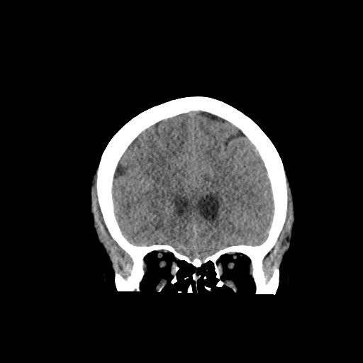 Acute subarachnoid hemorrhage and accessory anterior cerebral artery (Radiopaedia 69231-79008 Coronal non-contrast 23).jpg
