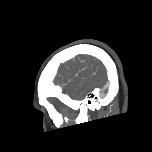 Acute subarachnoid hemorrhage and accessory anterior cerebral artery (Radiopaedia 69231-79009 Sagittal C+ arterial phase 61).jpg