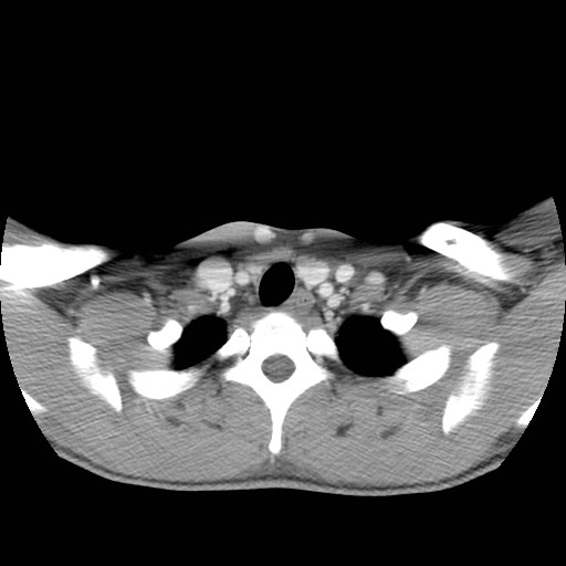 File:Acute submandibular sialadenitis secondary to ductal stone (Radiopaedia 27999-28267 Axial C+ delayed 43).jpg