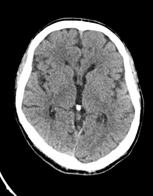 Acute superior cerebellar artery territory infarct (Radiopaedia 84104-99359 Axial non-contrast 37).jpg