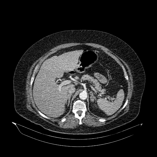 File:Acute superior mesenteric artery occlusion (Radiopaedia 51288-56960 Axial C+ arterial phase 22).jpg