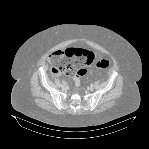 Acute superior mesenteric artery occlusion (Radiopaedia 51288-56960 Axial lung window 58).jpg