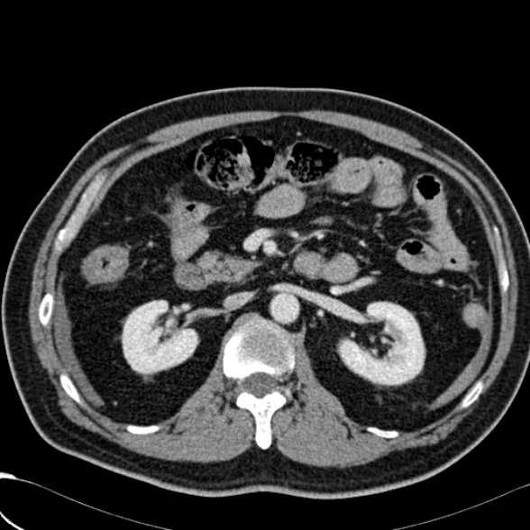 File:Acute traumatic mesenteric bleed (Radiopaedia 37561-39428 Axial C+ portal venous phase 66).jpg