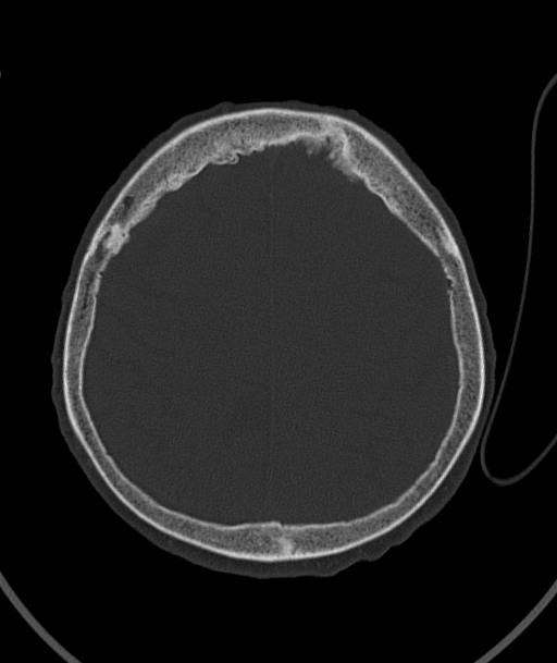 Acute traumatic subdural hematoma (Radiopaedia 82921-97257 Axial bone window 34).jpg