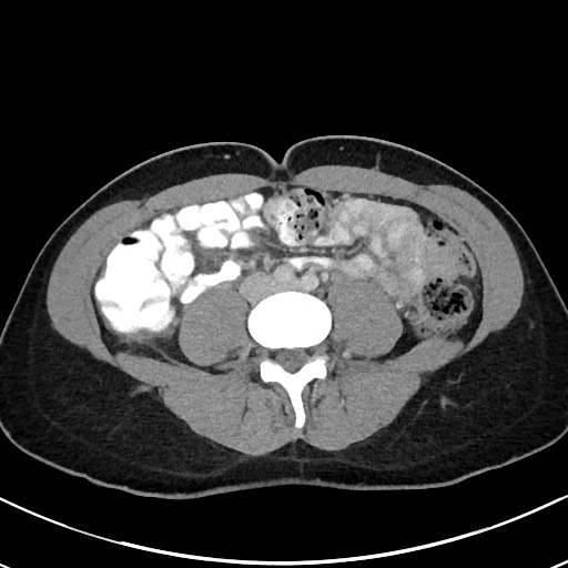 File:Acute uncomplicated appendicitis (Radiopaedia 61374-69304 Axial C+ portal venous phase 68).jpg