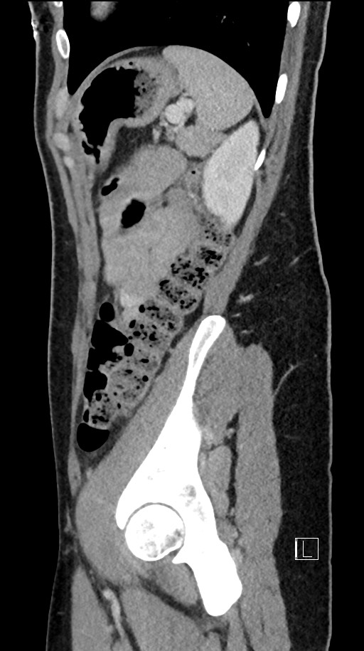 Acute uncomplicated appendicitis (Radiopaedia 61374-69304 Sagittal C+ portal venous phase 24).jpg